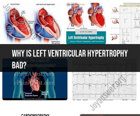 Dangers of Left Ventricular Hypertrophy 